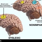 نارساخوانی و مغز