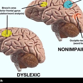 نارساخوانی و مغز