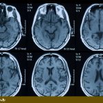 روشهای تصویربرداری مغزی - ام آر آی