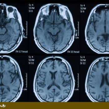 روشهای تصویربرداری مغزی - ام آر آی