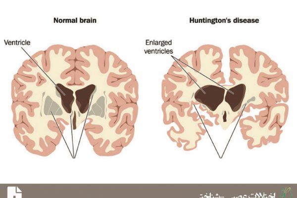 اختلال عصبی-شناختی عمده یا خفیف ناشی بیماری هانتینگتون (Major or Mild Neurocognitive Disorder Due to Huntington's Disease)