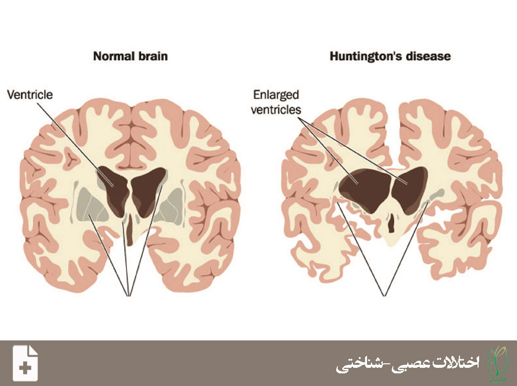 اختلال عصبی-شناختی عمده یا خفیف ناشی بیماری هانتینگتون (Major or Mild Neurocognitive Disorder Due to Huntington's Disease)