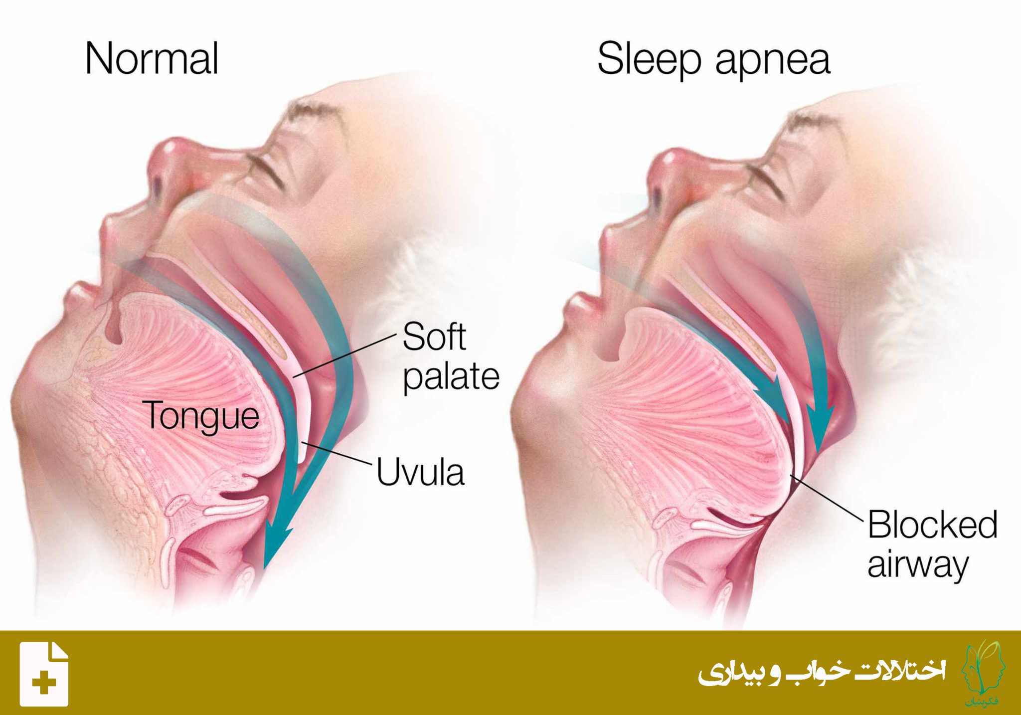 تنفس سطحی وقفه ی تنفسی انسدادی در خواب